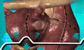 Ex-Maze Treatment for Atrial Fibrillation—6/19/07