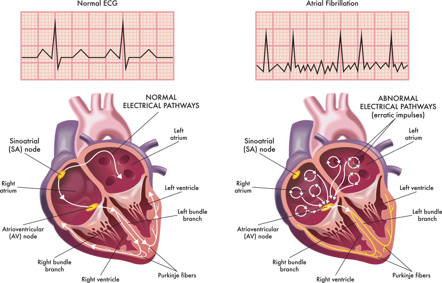 atrial-fibrillation-about-the-heart